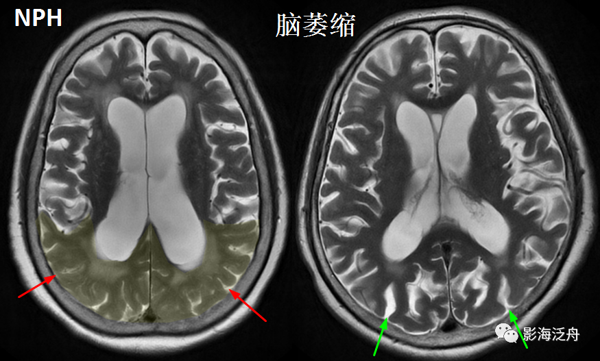 影像PPT - 【病例】小心误诊,这可不是单纯的脑萎缩!-12 影像PPT - 【病例】小心误诊,这可不是单纯的脑萎缩!-12