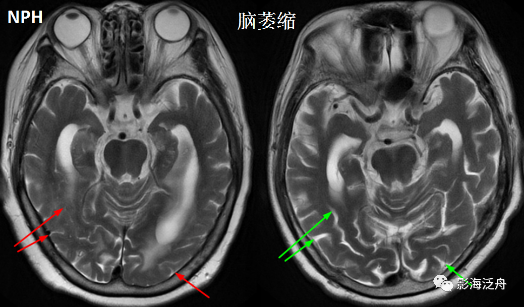 影像PPT - 【病例】小心误诊,这可不是单纯的脑萎缩!-13 影像PPT - 【病例】小心误诊,这可不是单纯的脑萎缩!-13