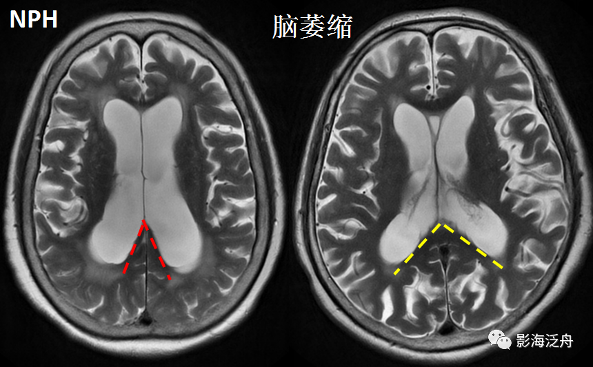 影像PPT - 【病例】小心误诊,这可不是单纯的脑萎缩!-16 影像PPT - 【病例】小心误诊,这可不是单纯的脑萎缩!-16