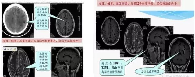 影像PPT - 腔隙性脑梗死诊疗中的9大雷区-2 影像PPT - 腔隙性脑梗死诊疗中的9大雷区-2