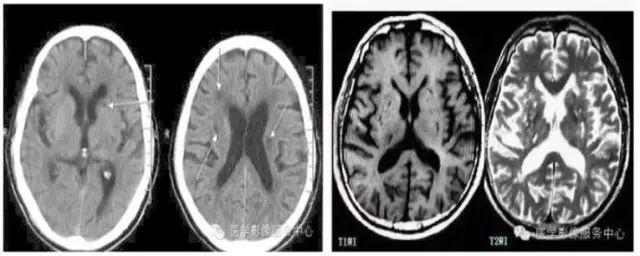 影像PPT - 腔隙性脑梗死诊疗中的9大雷区-3 影像PPT - 腔隙性脑梗死诊疗中的9大雷区-3