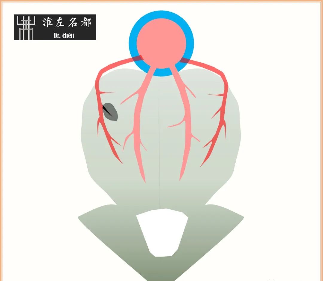 影像PPT - 图解脑桥梗死、豆纹动脉梗死机制 、解剖和示意图-4 影像PPT - 图解脑桥梗死、豆纹动脉梗死机制 、解剖和示意图-4