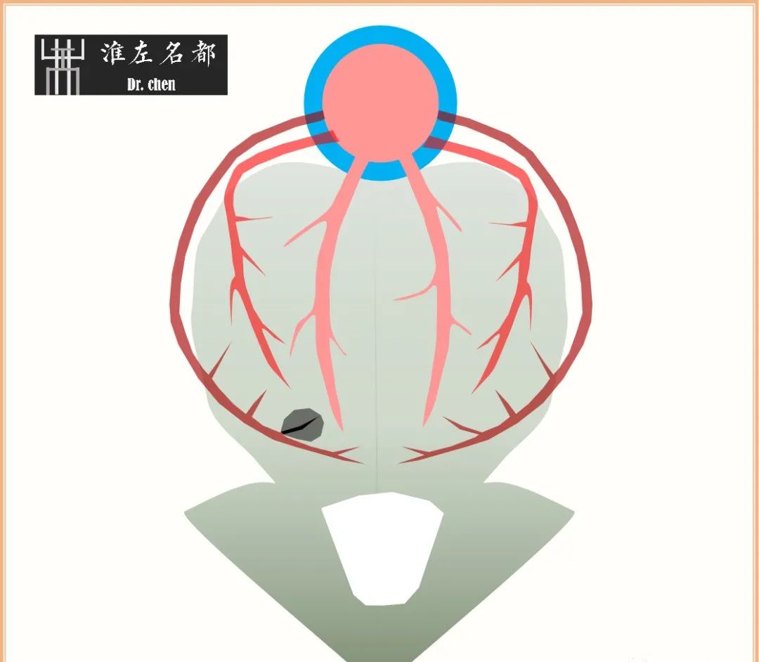 影像PPT - 图解脑桥梗死、豆纹动脉梗死机制 、解剖和示意图-5 影像PPT - 图解脑桥梗死、豆纹动脉梗死机制 、解剖和示意图-5