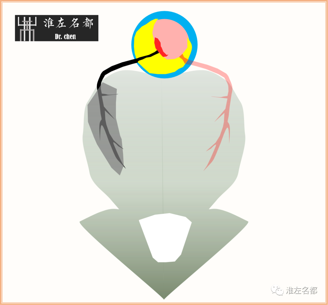 影像PPT - 图解脑桥梗死、豆纹动脉梗死机制 、解剖和示意图-16 影像PPT - 图解脑桥梗死、豆纹动脉梗死机制 、解剖和示意图-16