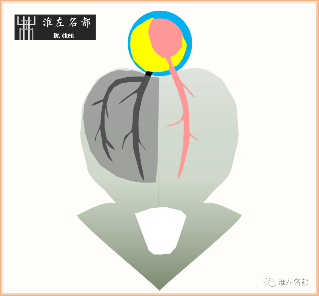 影像PPT - 图解脑桥梗死、豆纹动脉梗死机制 、解剖和示意图-14 影像PPT - 图解脑桥梗死、豆纹动脉梗死机制 、解剖和示意图-14