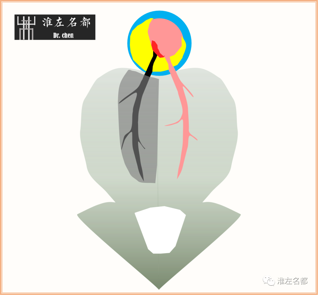 影像PPT - 图解脑桥梗死、豆纹动脉梗死机制 、解剖和示意图-15 影像PPT - 图解脑桥梗死、豆纹动脉梗死机制 、解剖和示意图-15