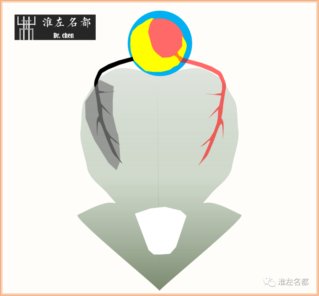 影像PPT - 图解脑桥梗死、豆纹动脉梗死机制 、解剖和示意图-13 影像PPT - 图解脑桥梗死、豆纹动脉梗死机制 、解剖和示意图-13