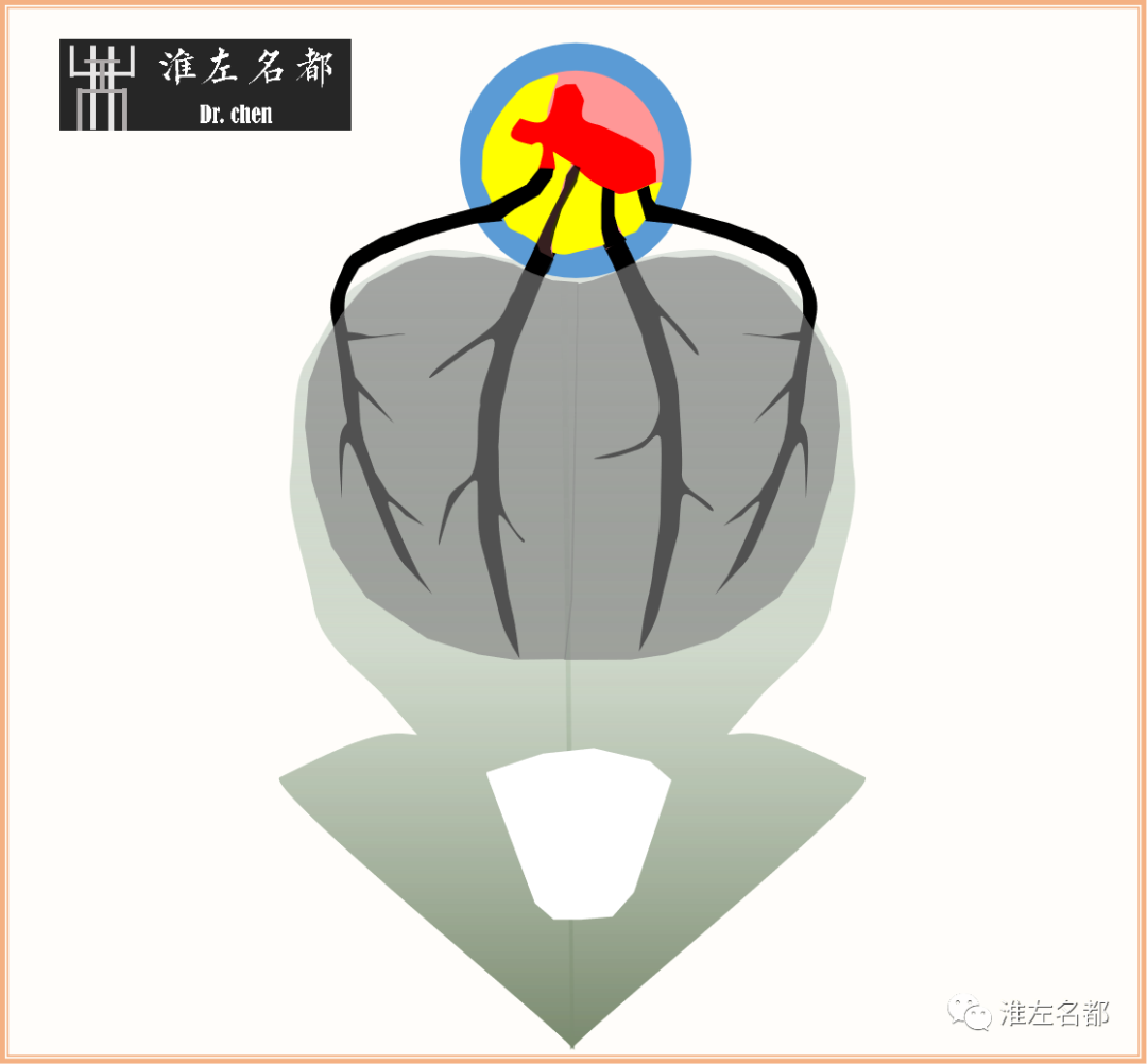 影像PPT - 图解脑桥梗死、豆纹动脉梗死机制 、解剖和示意图-18 影像PPT - 图解脑桥梗死、豆纹动脉梗死机制 、解剖和示意图-18