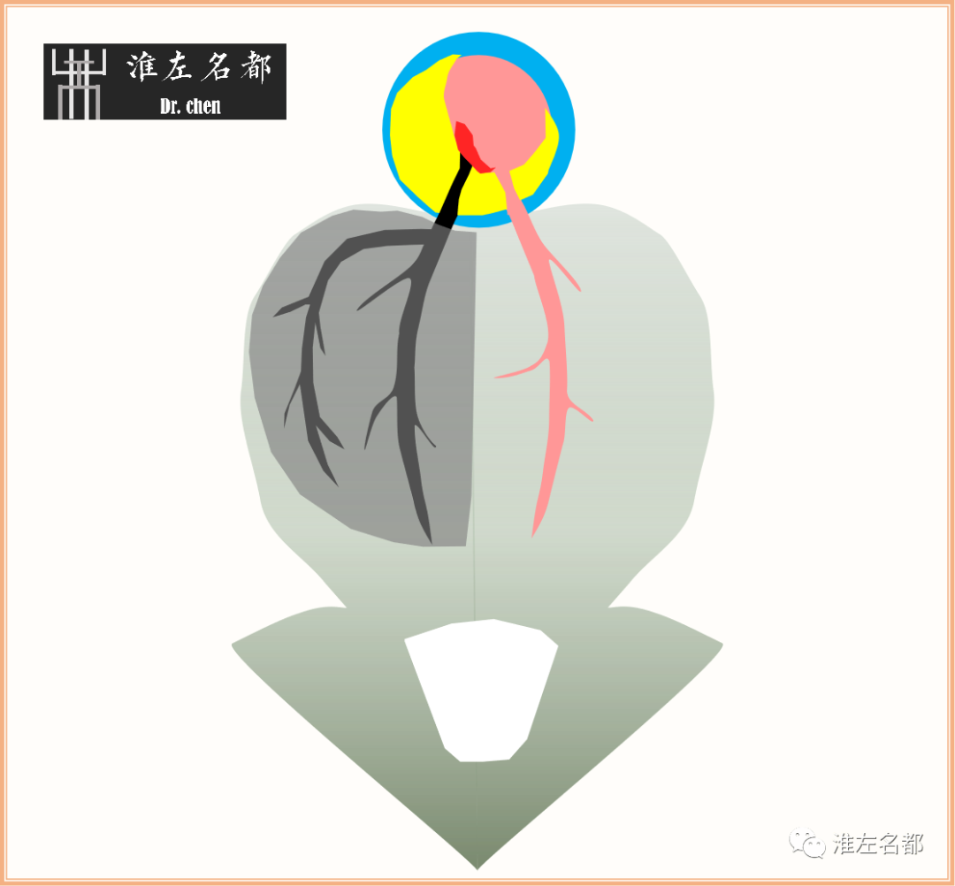 影像PPT - 图解脑桥梗死、豆纹动脉梗死机制 、解剖和示意图-17 影像PPT - 图解脑桥梗死、豆纹动脉梗死机制 、解剖和示意图-17