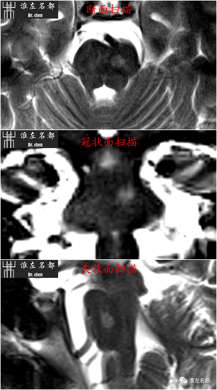 影像PPT - 图解脑桥梗死、豆纹动脉梗死机制 、解剖和示意图-21 影像PPT - 图解脑桥梗死、豆纹动脉梗死机制 、解剖和示意图-21