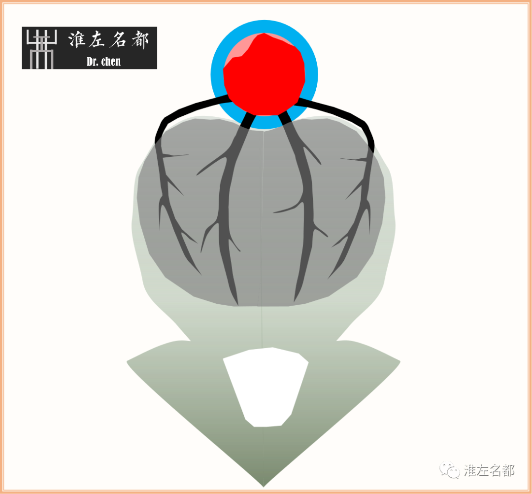 影像PPT - 图解脑桥梗死、豆纹动脉梗死机制 、解剖和示意图-19 影像PPT - 图解脑桥梗死、豆纹动脉梗死机制 、解剖和示意图-19