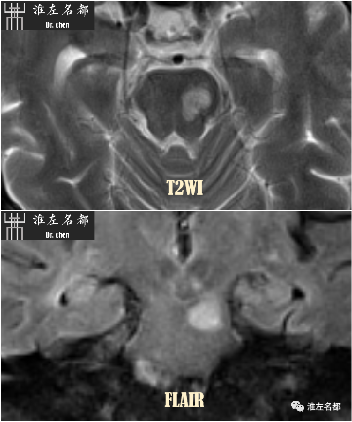 影像PPT - 图解脑桥梗死、豆纹动脉梗死机制 、解剖和示意图-25 影像PPT - 图解脑桥梗死、豆纹动脉梗死机制 、解剖和示意图-25