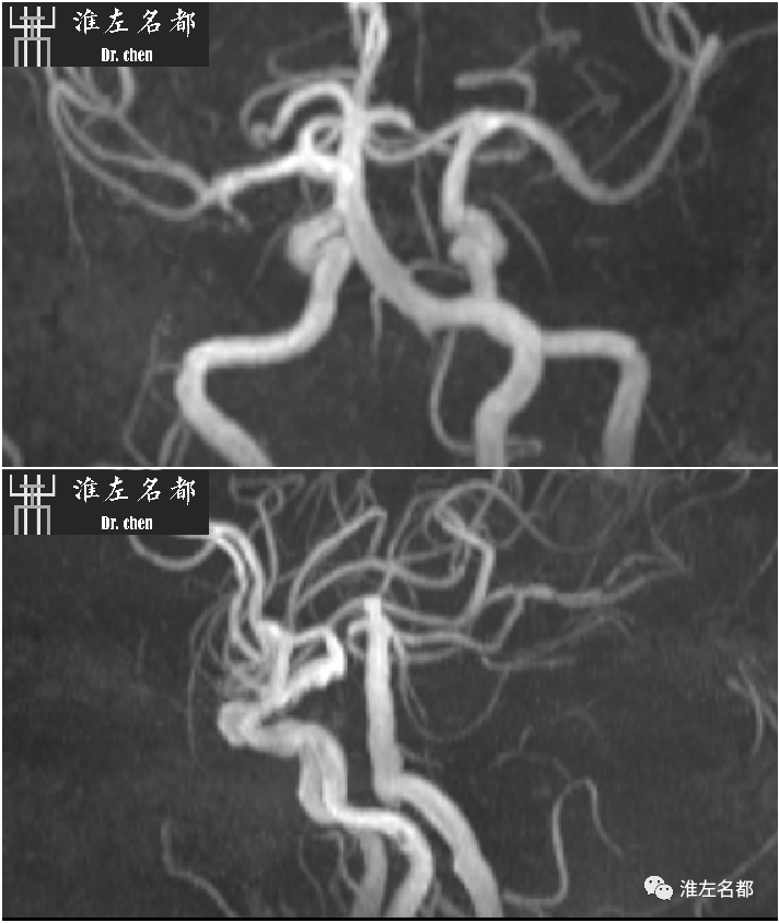 影像PPT - 图解脑桥梗死、豆纹动脉梗死机制 、解剖和示意图-26 影像PPT - 图解脑桥梗死、豆纹动脉梗死机制 、解剖和示意图-26