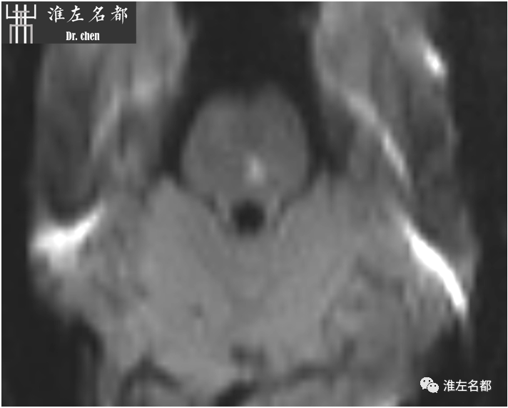 影像PPT - 图解脑桥梗死、豆纹动脉梗死机制 、解剖和示意图-23 影像PPT - 图解脑桥梗死、豆纹动脉梗死机制 、解剖和示意图-23