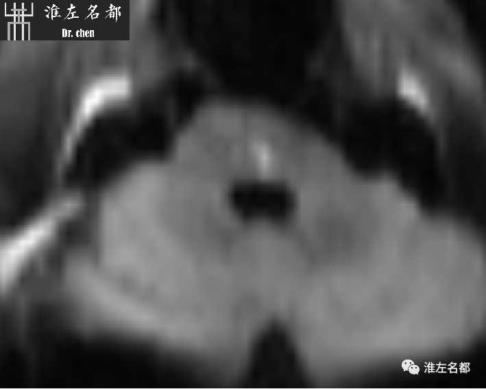 影像PPT - 图解脑桥梗死、豆纹动脉梗死机制 、解剖和示意图-27 影像PPT - 图解脑桥梗死、豆纹动脉梗死机制 、解剖和示意图-27