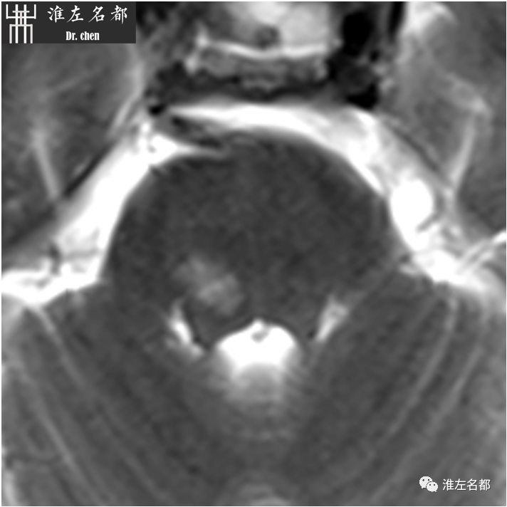 影像PPT - 图解脑桥梗死、豆纹动脉梗死机制 、解剖和示意图-31 影像PPT - 图解脑桥梗死、豆纹动脉梗死机制 、解剖和示意图-31