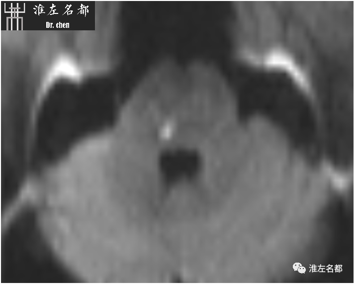 影像PPT - 图解脑桥梗死、豆纹动脉梗死机制 、解剖和示意图-29 影像PPT - 图解脑桥梗死、豆纹动脉梗死机制 、解剖和示意图-29