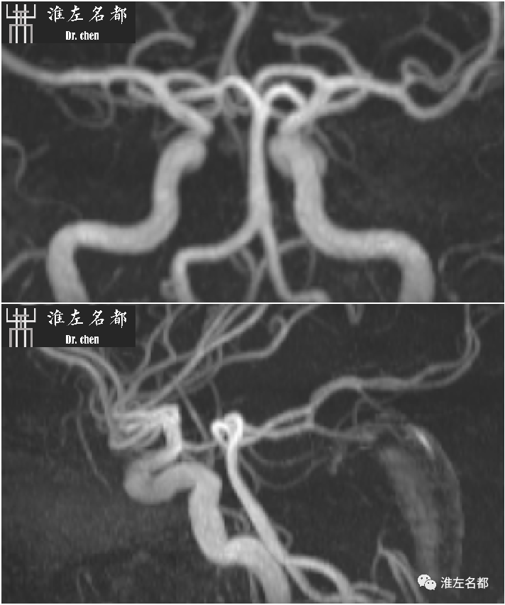 影像PPT - 图解脑桥梗死、豆纹动脉梗死机制 、解剖和示意图-28 影像PPT - 图解脑桥梗死、豆纹动脉梗死机制 、解剖和示意图-28