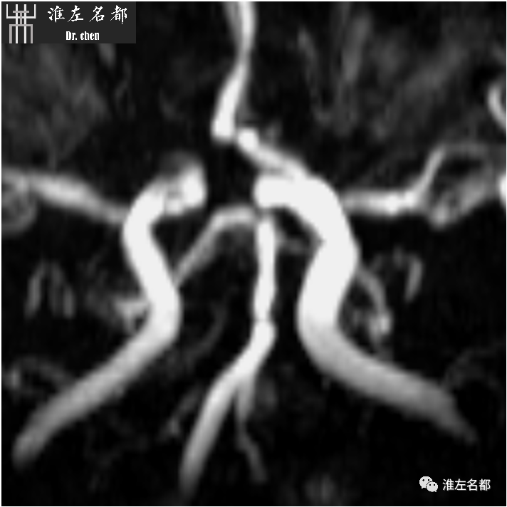 影像PPT - 图解脑桥梗死、豆纹动脉梗死机制 、解剖和示意图-32