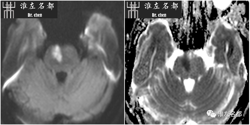 影像PPT - 图解脑桥梗死、豆纹动脉梗死机制 、解剖和示意图-35 影像PPT - 图解脑桥梗死、豆纹动脉梗死机制 、解剖和示意图-35