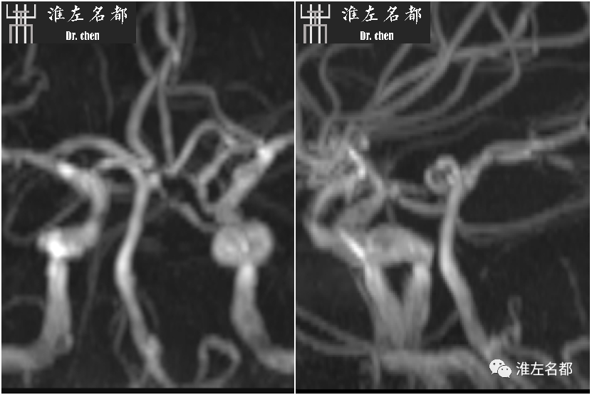 影像PPT - 图解脑桥梗死、豆纹动脉梗死机制 、解剖和示意图-34 影像PPT - 图解脑桥梗死、豆纹动脉梗死机制 、解剖和示意图-34