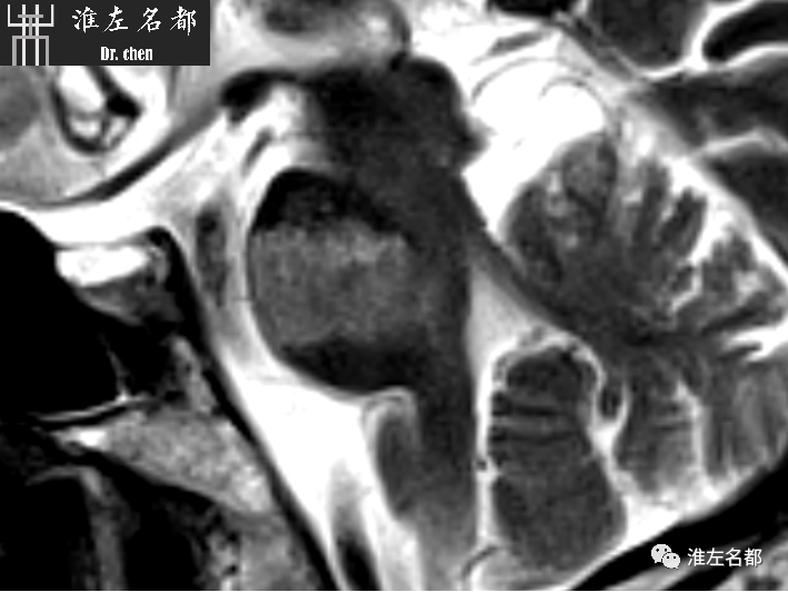 影像PPT - 图解脑桥梗死、豆纹动脉梗死机制 、解剖和示意图-38 影像PPT - 图解脑桥梗死、豆纹动脉梗死机制 、解剖和示意图-38