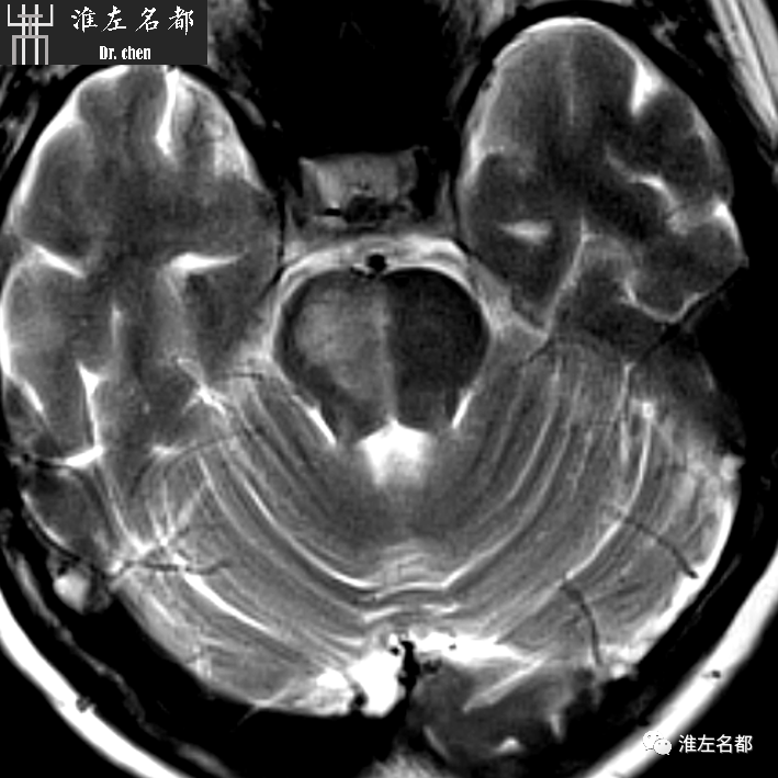 影像PPT - 图解脑桥梗死、豆纹动脉梗死机制 、解剖和示意图-40 影像PPT - 图解脑桥梗死、豆纹动脉梗死机制 、解剖和示意图-40