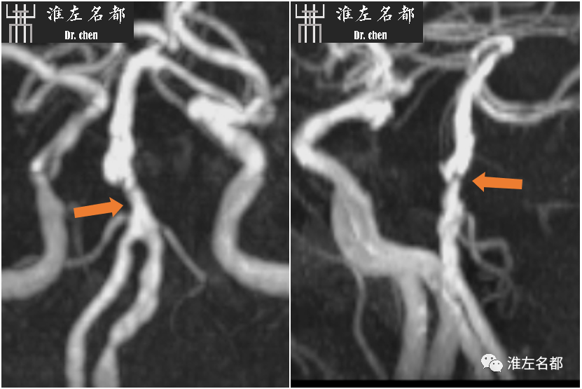 影像PPT - 图解脑桥梗死、豆纹动脉梗死机制 、解剖和示意图-44 影像PPT - 图解脑桥梗死、豆纹动脉梗死机制 、解剖和示意图-44