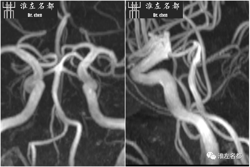 影像PPT - 图解脑桥梗死、豆纹动脉梗死机制 、解剖和示意图-41 影像PPT - 图解脑桥梗死、豆纹动脉梗死机制 、解剖和示意图-41