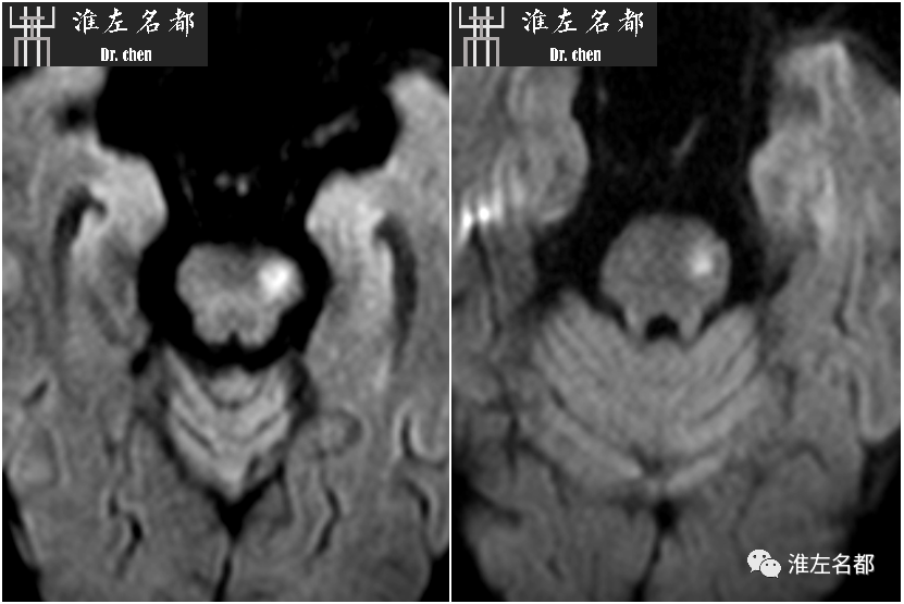 影像PPT - 图解脑桥梗死、豆纹动脉梗死机制 、解剖和示意图-47 影像PPT - 图解脑桥梗死、豆纹动脉梗死机制 、解剖和示意图-47