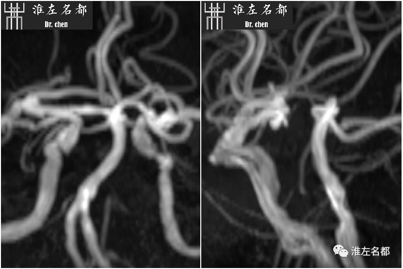 影像PPT - 图解脑桥梗死、豆纹动脉梗死机制 、解剖和示意图-46 影像PPT - 图解脑桥梗死、豆纹动脉梗死机制 、解剖和示意图-46