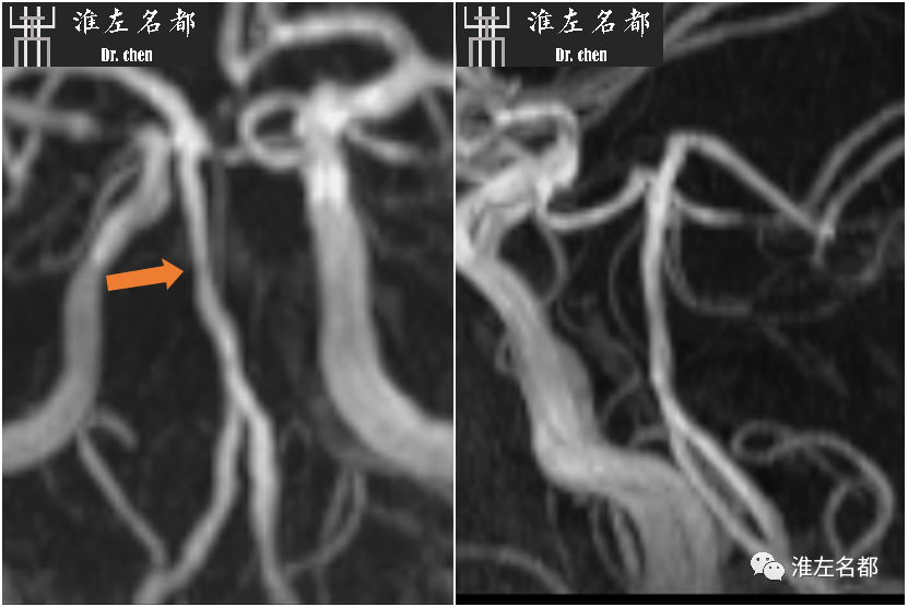影像PPT - 图解脑桥梗死、豆纹动脉梗死机制 、解剖和示意图-50 影像PPT - 图解脑桥梗死、豆纹动脉梗死机制 、解剖和示意图-50