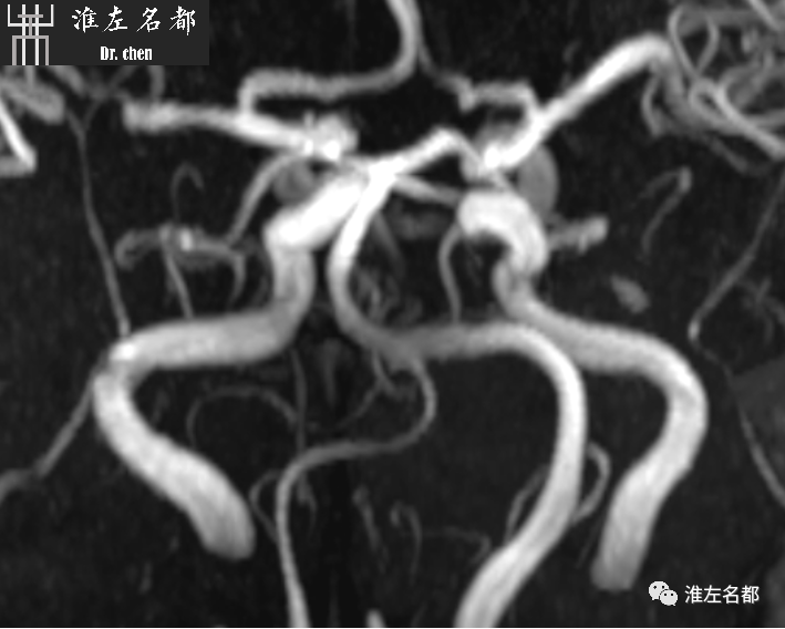 影像PPT - 图解脑桥梗死、豆纹动脉梗死机制 、解剖和示意图-48 影像PPT - 图解脑桥梗死、豆纹动脉梗死机制 、解剖和示意图-48