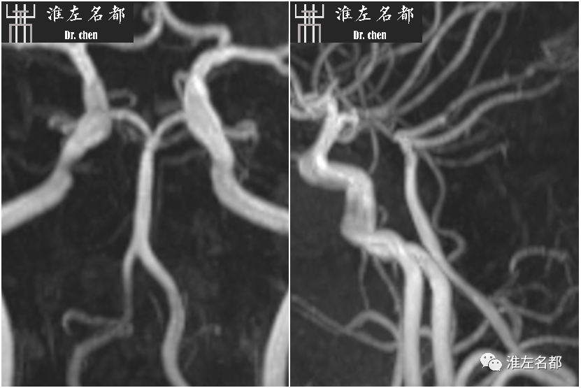 影像PPT - 图解脑桥梗死、豆纹动脉梗死机制 、解剖和示意图-54 影像PPT - 图解脑桥梗死、豆纹动脉梗死机制 、解剖和示意图-54