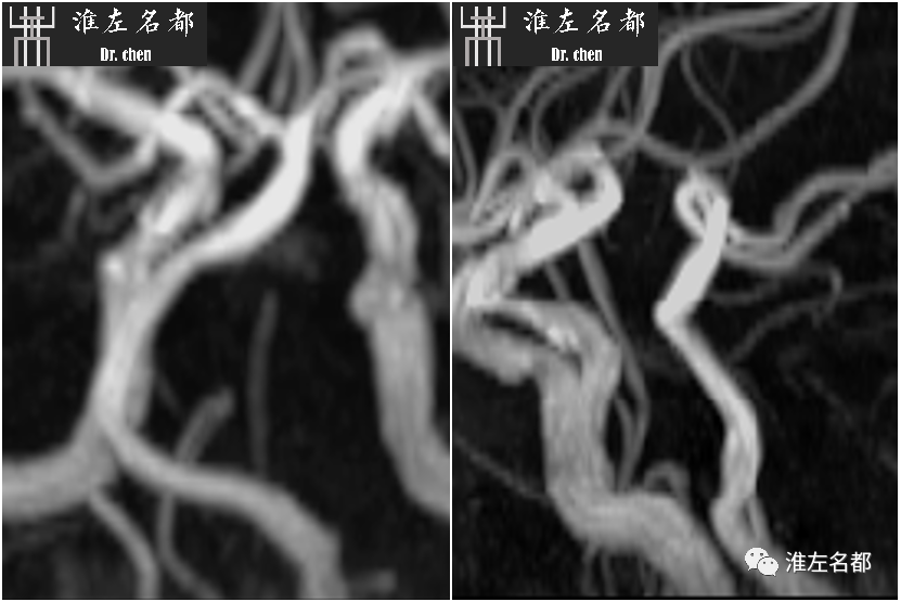 影像PPT - 图解脑桥梗死、豆纹动脉梗死机制 、解剖和示意图-52 影像PPT - 图解脑桥梗死、豆纹动脉梗死机制 、解剖和示意图-52
