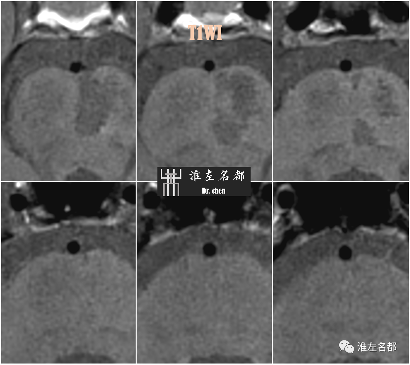 影像PPT - 图解脑桥梗死、豆纹动脉梗死机制 、解剖和示意图-57 影像PPT - 图解脑桥梗死、豆纹动脉梗死机制 、解剖和示意图-57