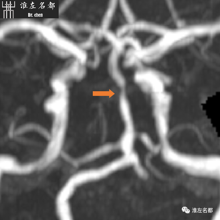 影像PPT - 图解脑桥梗死、豆纹动脉梗死机制 、解剖和示意图-62 影像PPT - 图解脑桥梗死、豆纹动脉梗死机制 、解剖和示意图-62