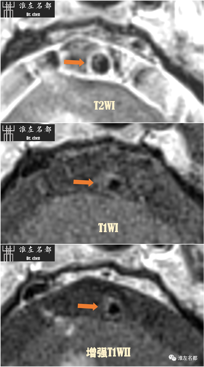 影像PPT - 图解脑桥梗死、豆纹动脉梗死机制 、解剖和示意图-64 影像PPT - 图解脑桥梗死、豆纹动脉梗死机制 、解剖和示意图-64