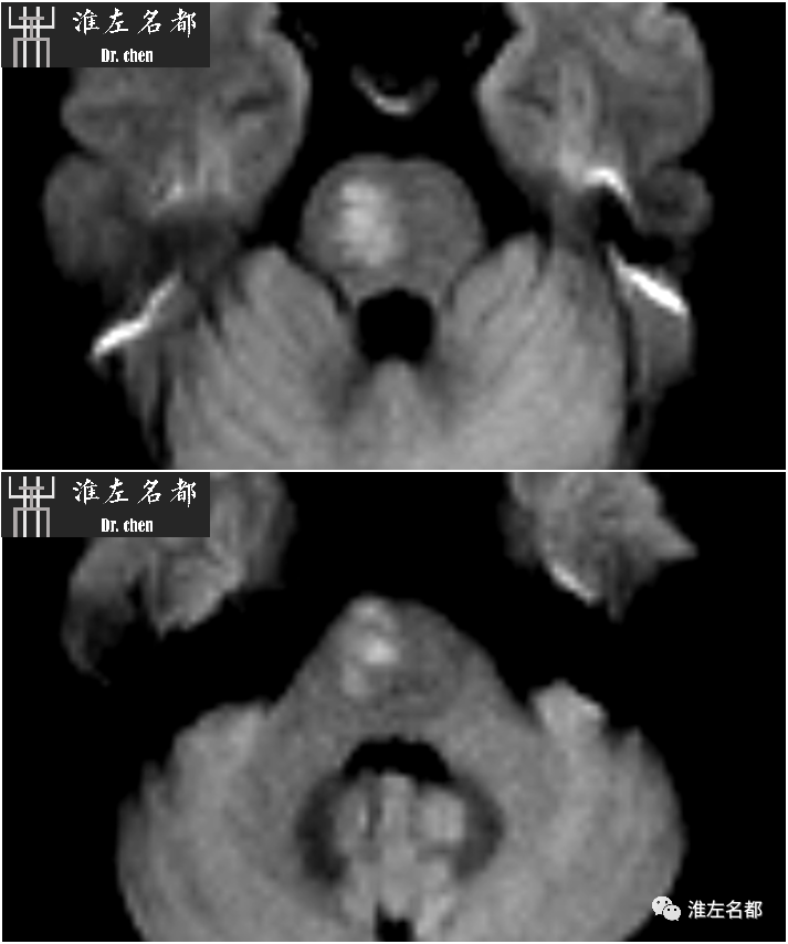 影像PPT - 图解脑桥梗死、豆纹动脉梗死机制 、解剖和示意图-63 影像PPT - 图解脑桥梗死、豆纹动脉梗死机制 、解剖和示意图-63