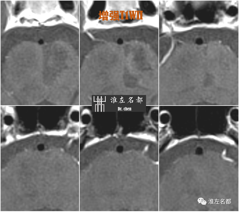 影像PPT - 图解脑桥梗死、豆纹动脉梗死机制 、解剖和示意图-58 影像PPT - 图解脑桥梗死、豆纹动脉梗死机制 、解剖和示意图-58
