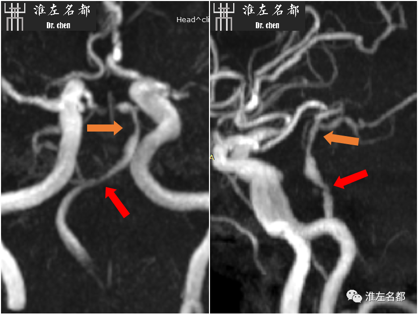 影像PPT - 图解脑桥梗死、豆纹动脉梗死机制 、解剖和示意图-65 影像PPT - 图解脑桥梗死、豆纹动脉梗死机制 、解剖和示意图-65