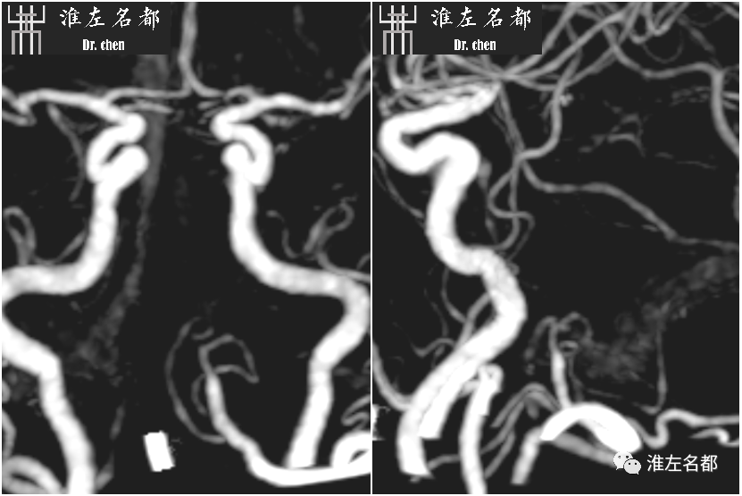 影像PPT - 图解脑桥梗死、豆纹动脉梗死机制 、解剖和示意图-70 影像PPT - 图解脑桥梗死、豆纹动脉梗死机制 、解剖和示意图-70
