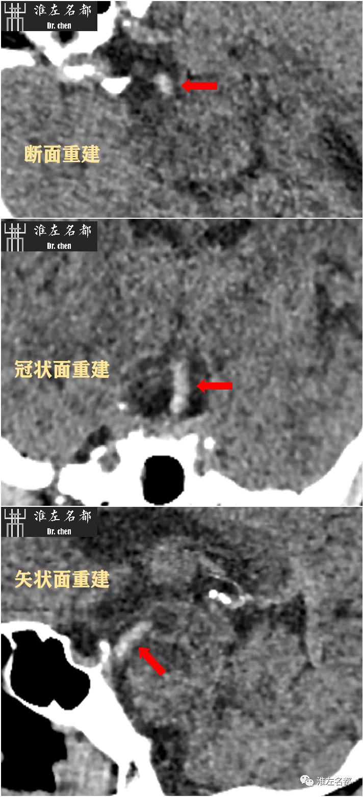 影像PPT - 图解脑桥梗死、豆纹动脉梗死机制 、解剖和示意图-69 影像PPT - 图解脑桥梗死、豆纹动脉梗死机制 、解剖和示意图-69