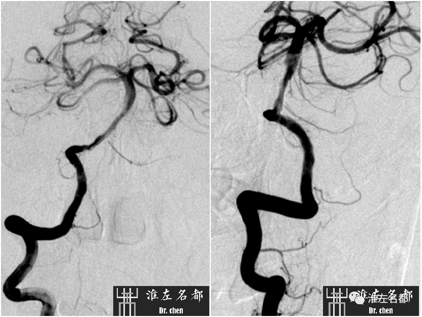 影像PPT - 图解脑桥梗死、豆纹动脉梗死机制 、解剖和示意图-72 影像PPT - 图解脑桥梗死、豆纹动脉梗死机制 、解剖和示意图-72