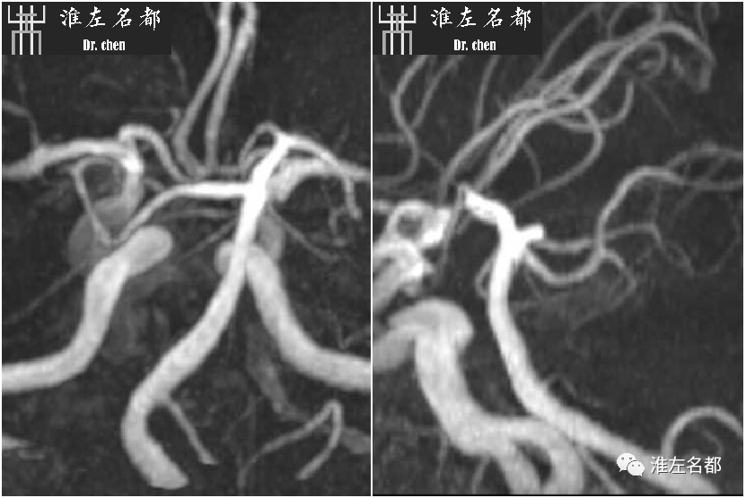 影像PPT - 图解脑桥梗死、豆纹动脉梗死机制 、解剖和示意图-73 影像PPT - 图解脑桥梗死、豆纹动脉梗死机制 、解剖和示意图-73
