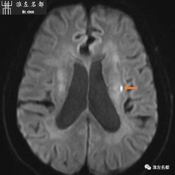 影像PPT - 图解脑桥梗死、豆纹动脉梗死机制 、解剖和示意图-77 影像PPT - 图解脑桥梗死、豆纹动脉梗死机制 、解剖和示意图-77