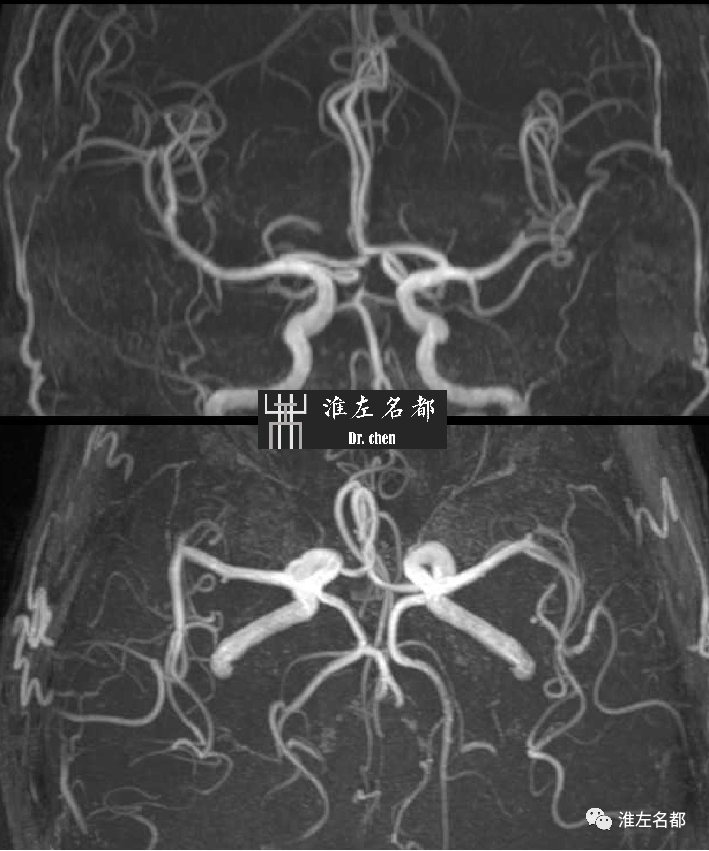 影像PPT - 图解脑桥梗死、豆纹动脉梗死机制 、解剖和示意图-76 影像PPT - 图解脑桥梗死、豆纹动脉梗死机制 、解剖和示意图-76