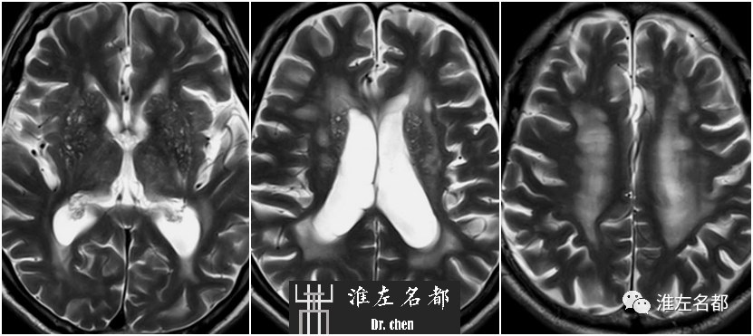 影像PPT - 图解脑桥梗死、豆纹动脉梗死机制 、解剖和示意图-78 影像PPT - 图解脑桥梗死、豆纹动脉梗死机制 、解剖和示意图-78