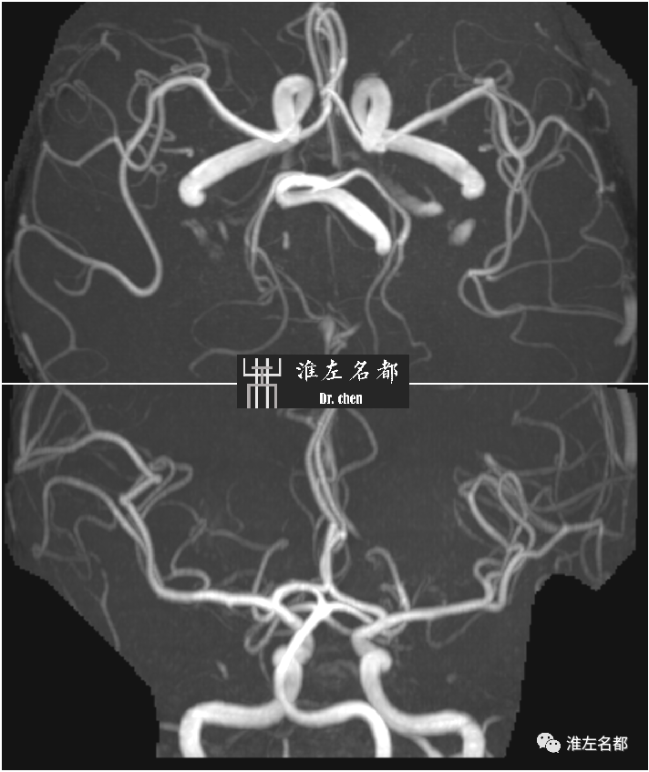 影像PPT - 图解脑桥梗死、豆纹动脉梗死机制 、解剖和示意图-81 影像PPT - 图解脑桥梗死、豆纹动脉梗死机制 、解剖和示意图-81
