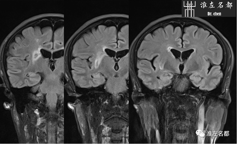 影像PPT - 图解脑桥梗死、豆纹动脉梗死机制 、解剖和示意图-83 影像PPT - 图解脑桥梗死、豆纹动脉梗死机制 、解剖和示意图-83